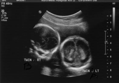Twin Girls